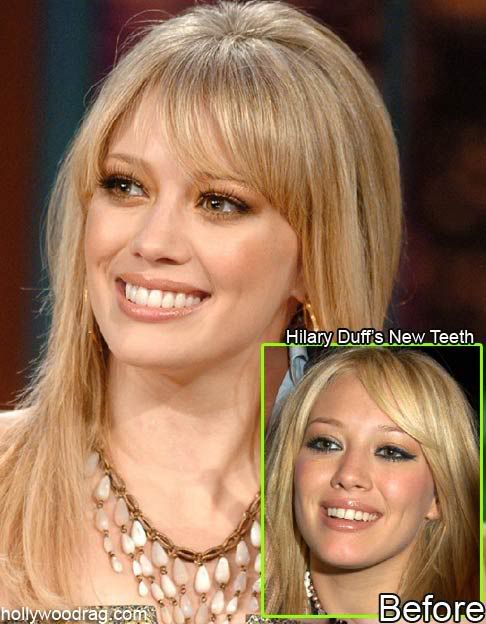Hilary Duff - Teeth and Bones. - Oh No They Didn't!