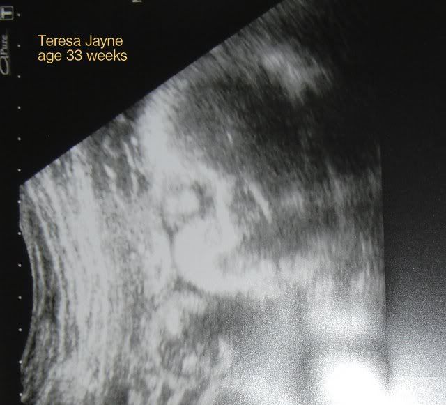 Teresa Jayne,Baby Scan