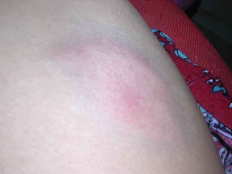 Bruise aiyoyoh...