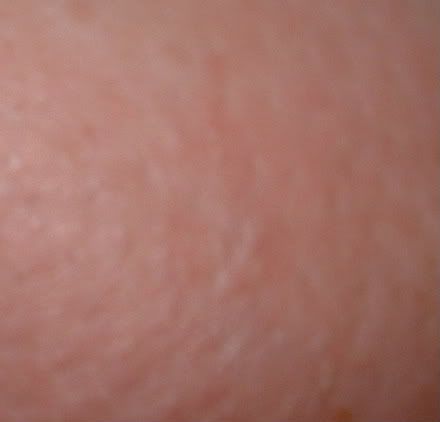 Cellulitis is back...