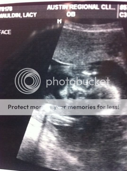 What does a cleft lip look like on ultrasound? BabyCenter